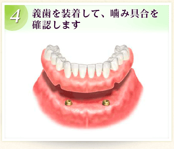 4.義歯を装着して、噛み具合を確認します