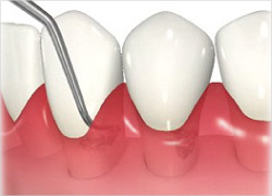 歯ぐきの治療・口腔内のメンテナンス