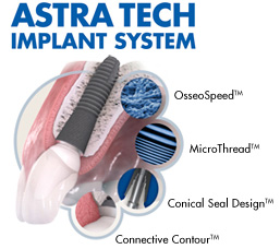 astra tech implant system
