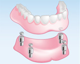 磁気アタッチメント義歯（保険適用外）